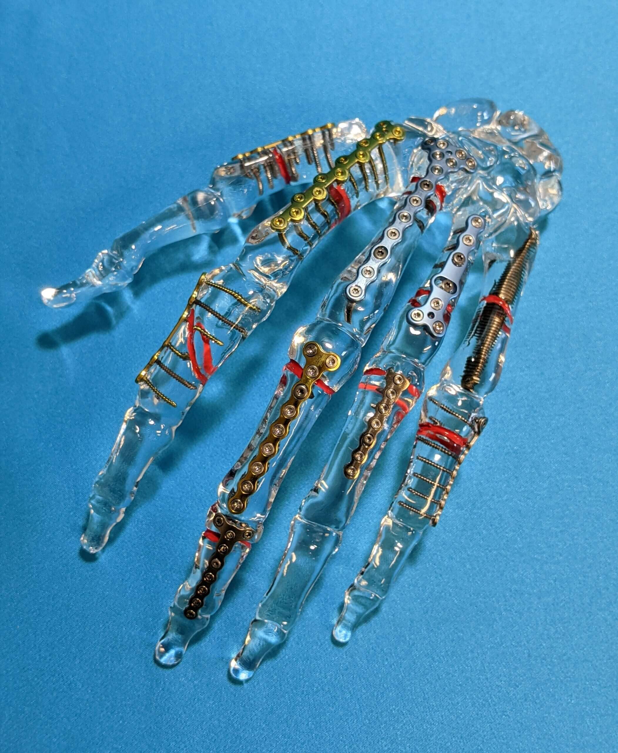Acrylic Hand Fracture Plates Encoris scaled