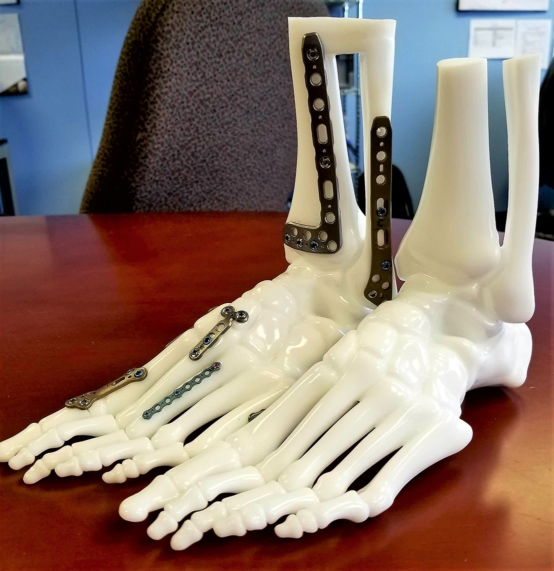 FlexBone Foot Ankle Models Bone Color Self Applied Implants ENCORIS