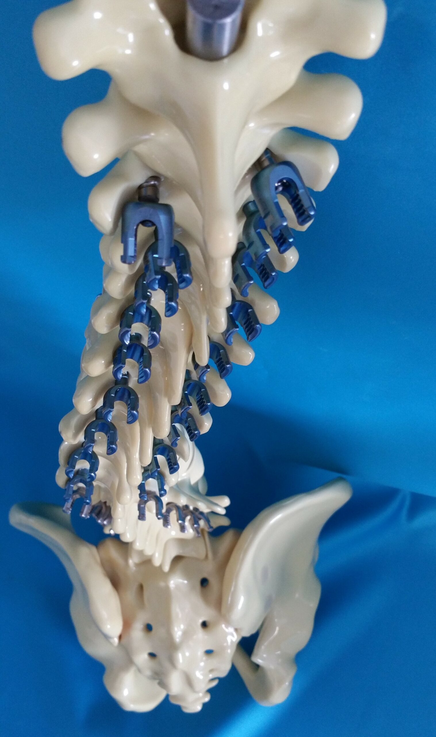 Flexbone Full Spine Replaceable Pedicle Screw Model Encoris 1 scaled